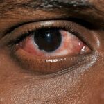 The Best Eye Drops for Conjunctivitis Relief in Ghana
