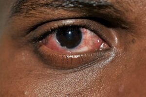 Read more about the article The Best Eye Drops for Conjunctivitis Relief in Ghana