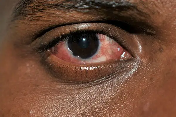 You are currently viewing The Best Eye Drops for Conjunctivitis Relief in Ghana